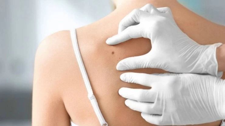 Kαρκίνος του δέρματος: Ποιοι κινδυνεύουν περισσότερο;